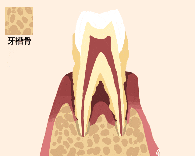 牙龈下的结石-2.gif