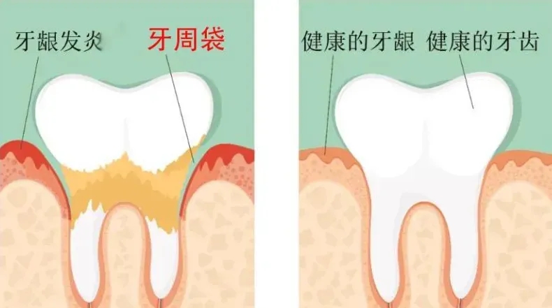 牙龈下的结石-3.jpg