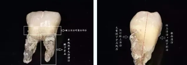 牙龈下的结石-5.jpg
